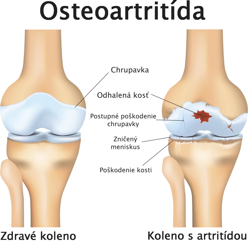 Artritída kolena - osteoartritída