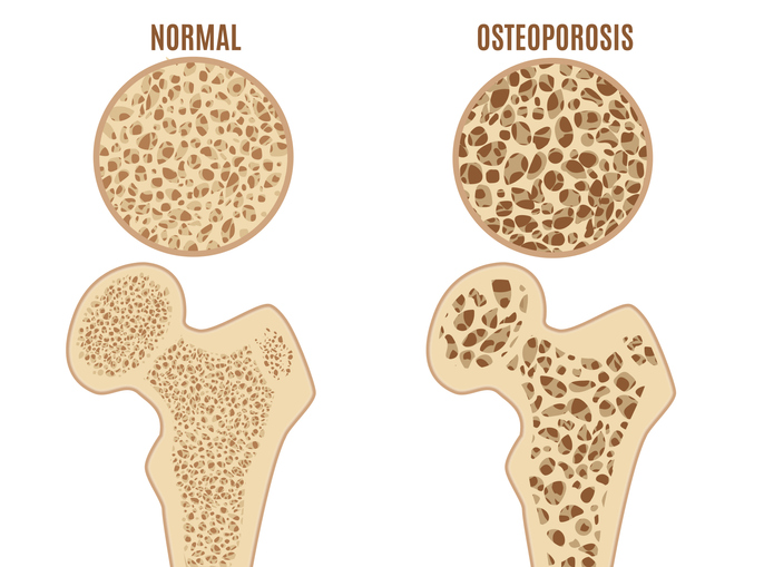 Osteoporóza stehennej kosti