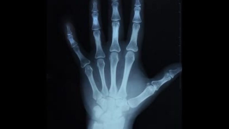 Osteoporóza
