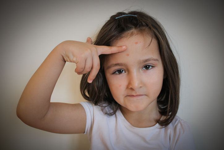 Varicella zoster virus - dievča s výsevom na tvári