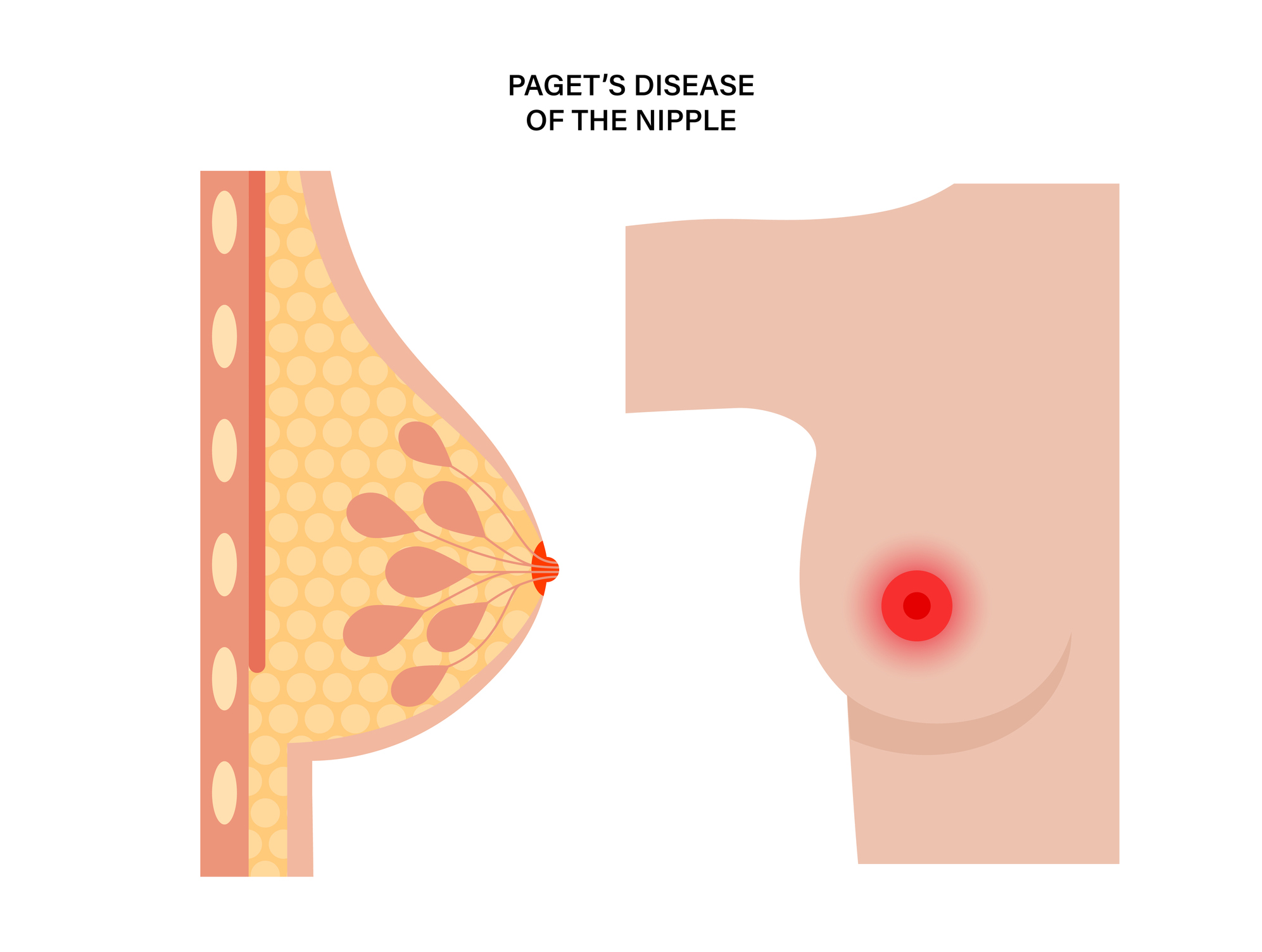Pagetova choroba prsníka - bradavky