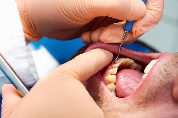 Paradentóza: Prečo vzniká? + Ako zastaviť kývanie zubov a spevniť ich?