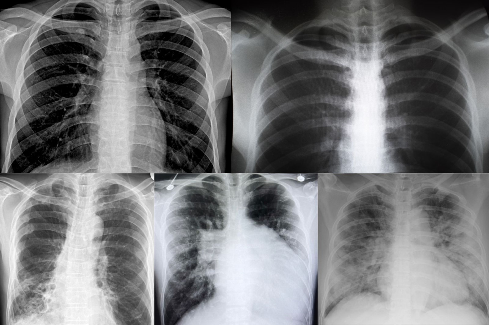 RTG snímky, Xray, pľúc, koláž - dva horné snímky - zdravé pľúcne tkanivo, dolné tri zápalové alebo iné zmeny pľúcneho tkaniva - zvýraznená bledá farba