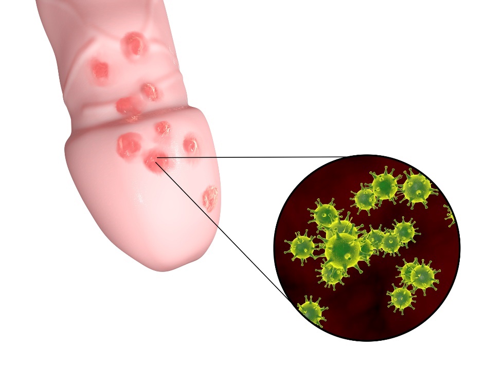 Tvorba drobných pľuzgierov genitálneho herpesu v oblasti pohlavného mužského orgánu