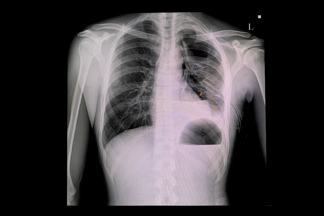 Röntgenový snímok Pneumotoraxu ľavej časti pľúc a nahromadenie vzduchu v pleurálnej dutine hrudníku (biela farba)