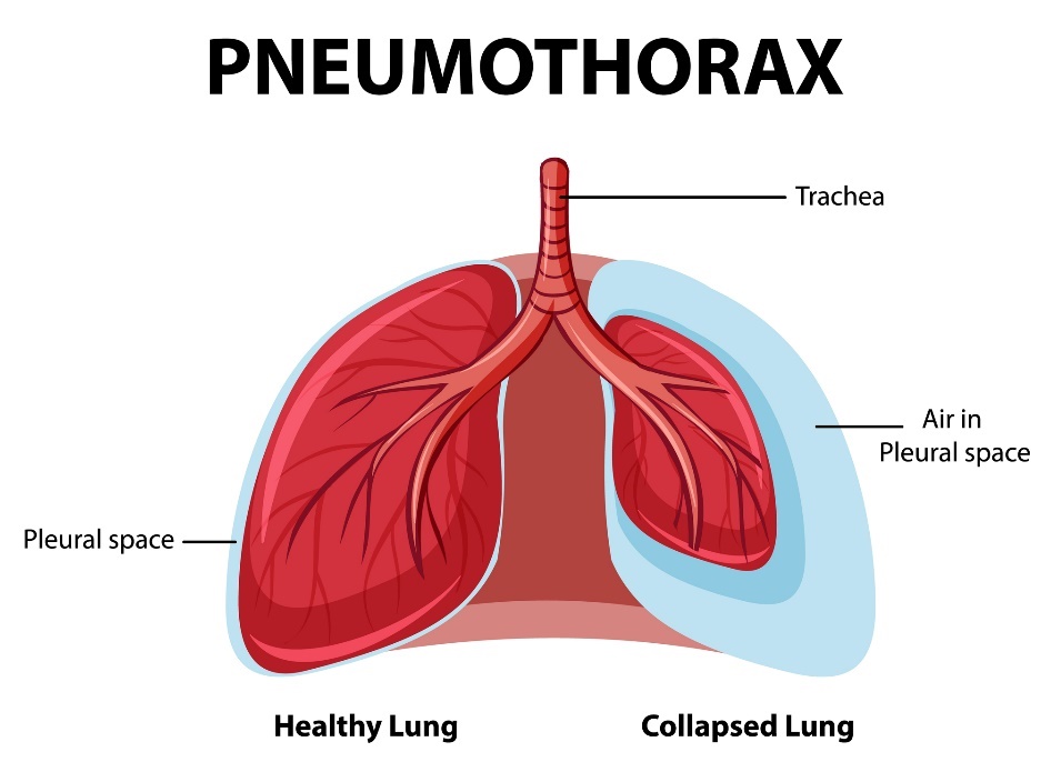 Pneumotorax: zdravé a kolabujúce pľúca