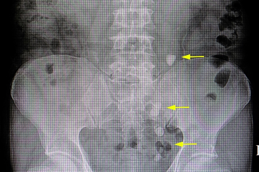 Röntgenový snímok: početné konkrementy v priebehu močových ciest