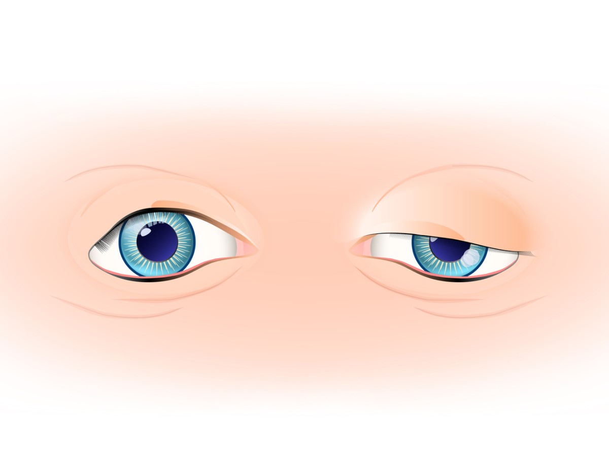 Ptóza viečka, ľavé očné viečko v normálnom stave a pravé očné viečko s poklesom - ptózou