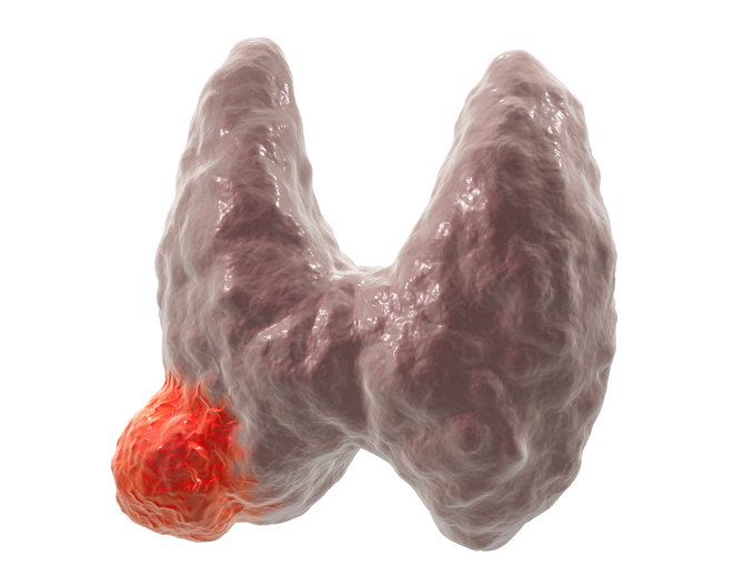 Rakovina štítnej žľazy - anatomický obrázok