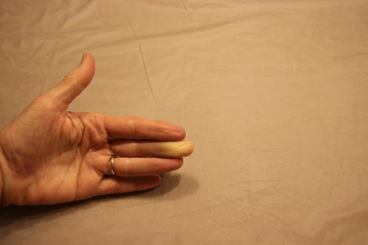 Raynaudov syndróm: Aká je príčina nedokrvenia prstov na rukách?