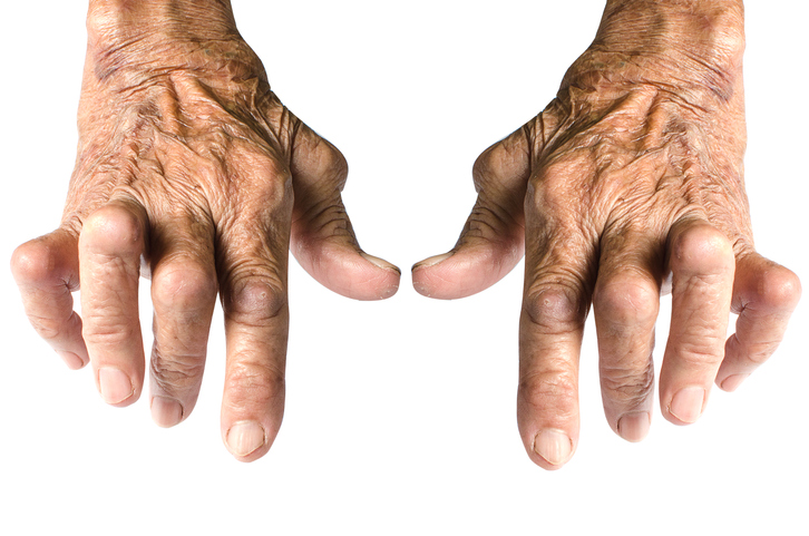 Typické deformity rúk pri reumatoidnej artritíde