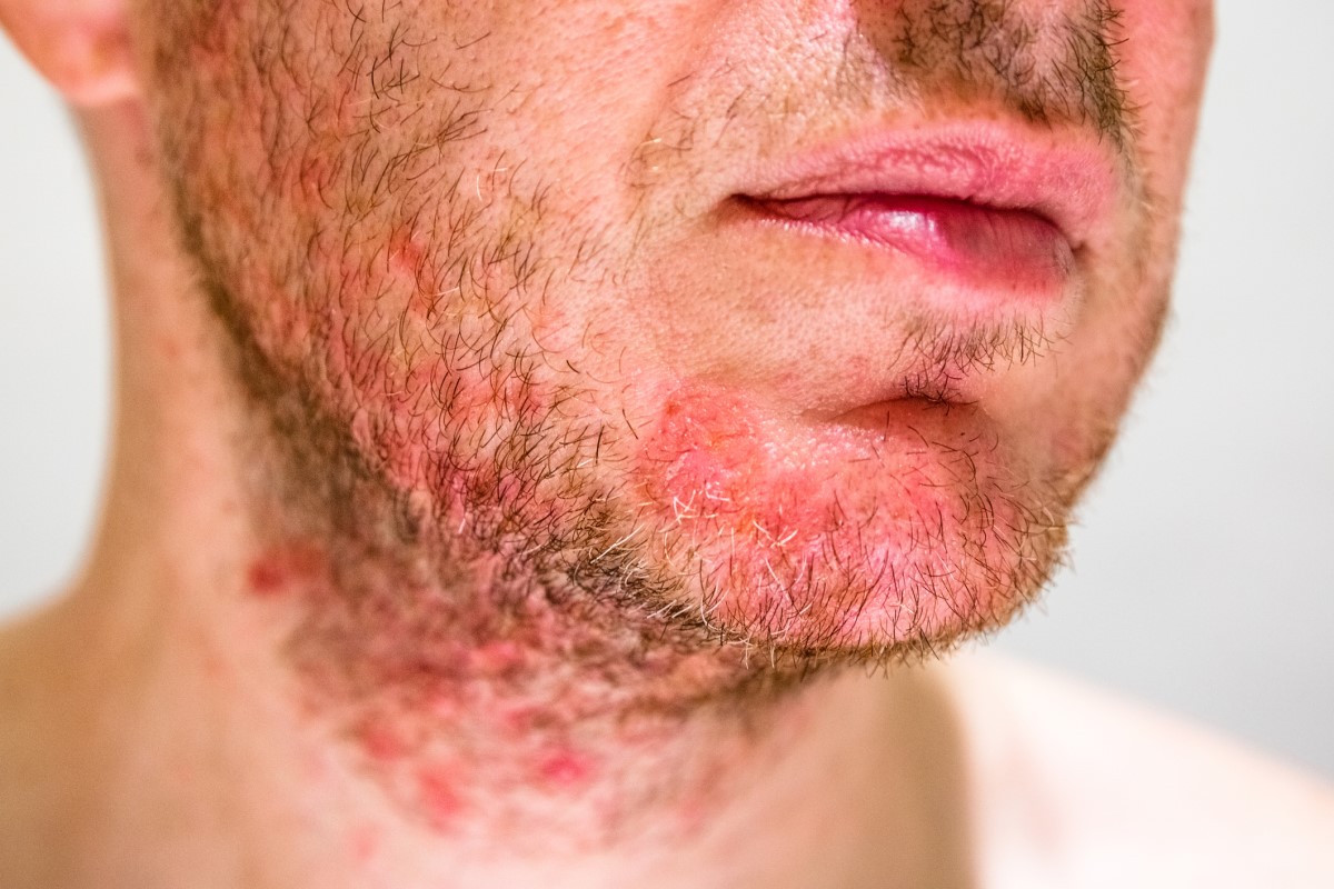 Muž so seboreou na brade, tvár začervenaná s príznakom dermatitídy