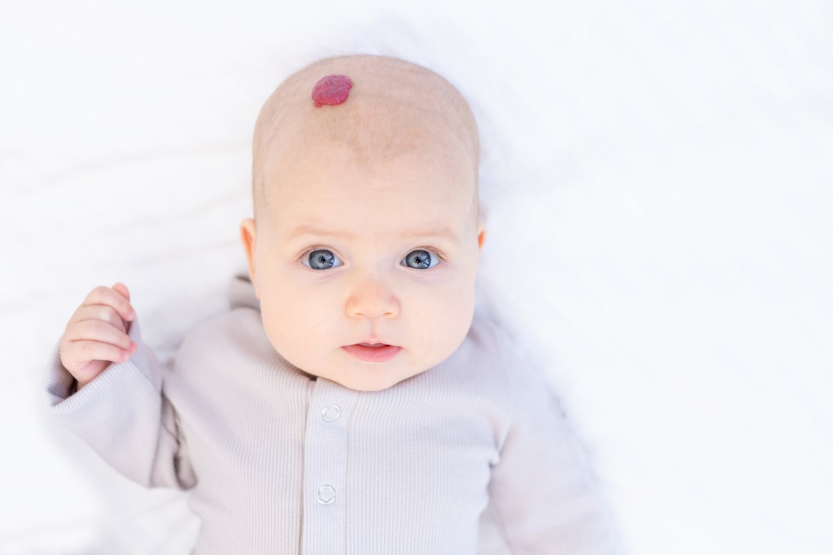 Hemangiom na hlave dieťaťa - častý výskyt
