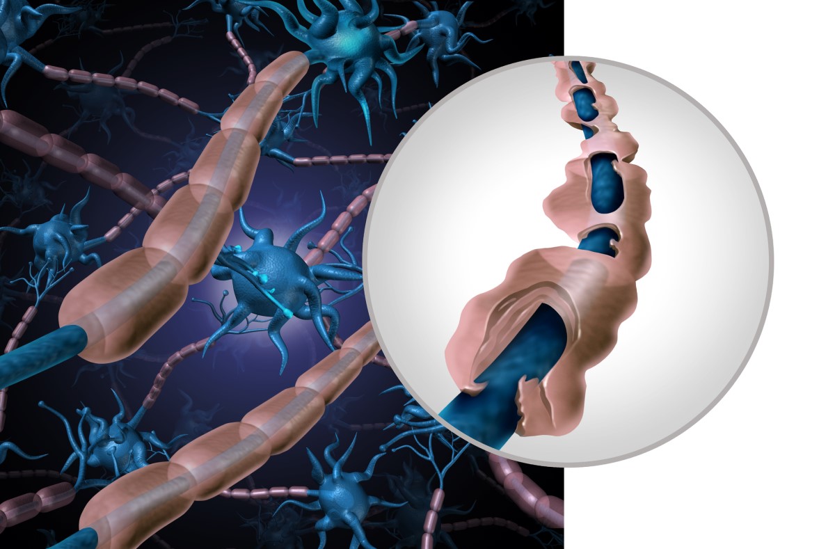 Anatomické, ilustračné znázornenie zdravého a poškodeného neurónu - demyelinizované vlákno