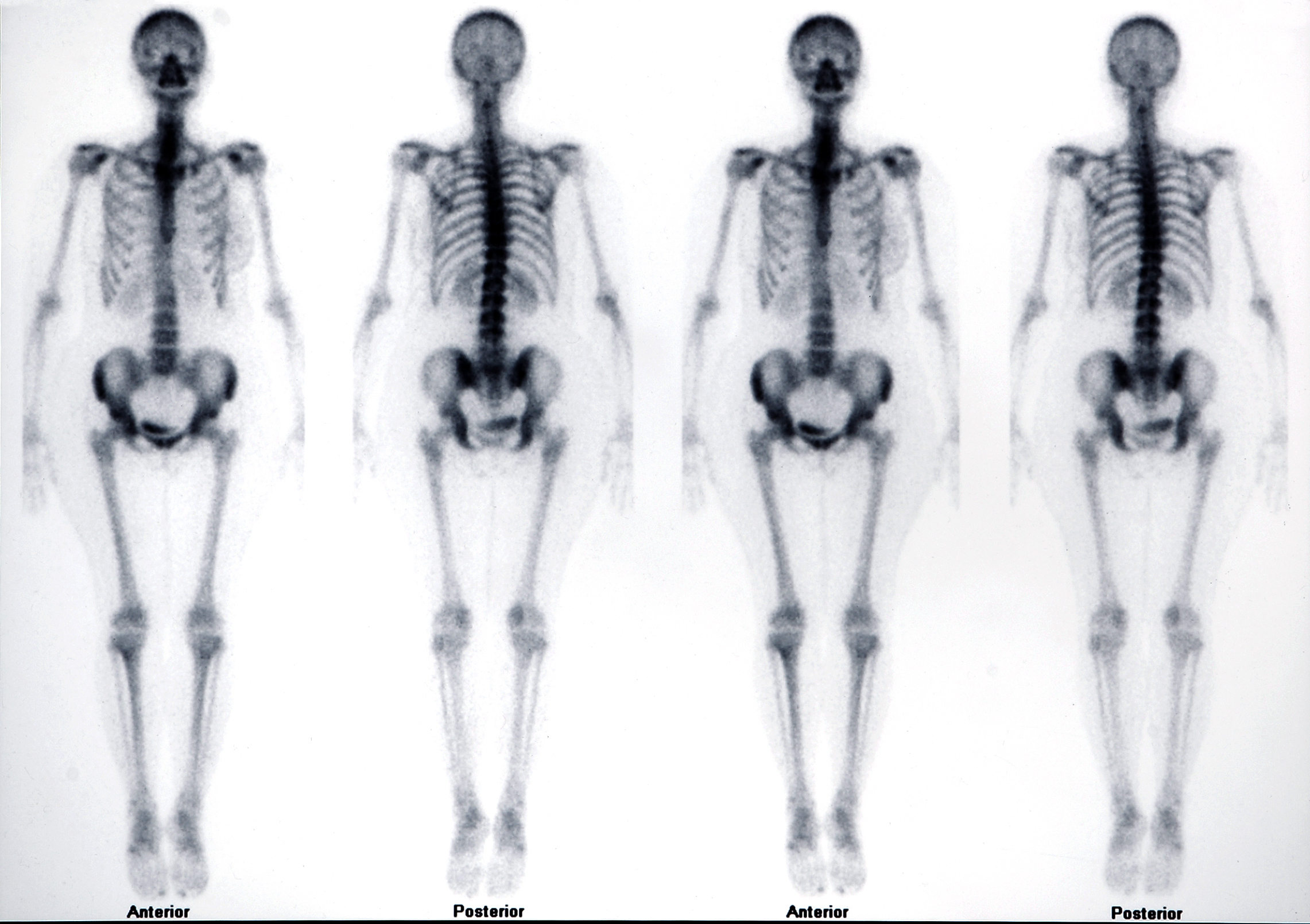 Výsledný snímok celkovej kostnej scintigrafie