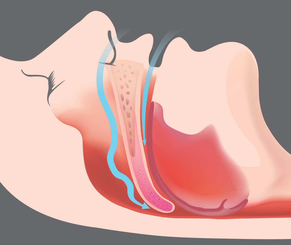 Obštrukčné apnoe a prekážka v dýchacích cestách - animovaný obrázok a model dýchacích ciest