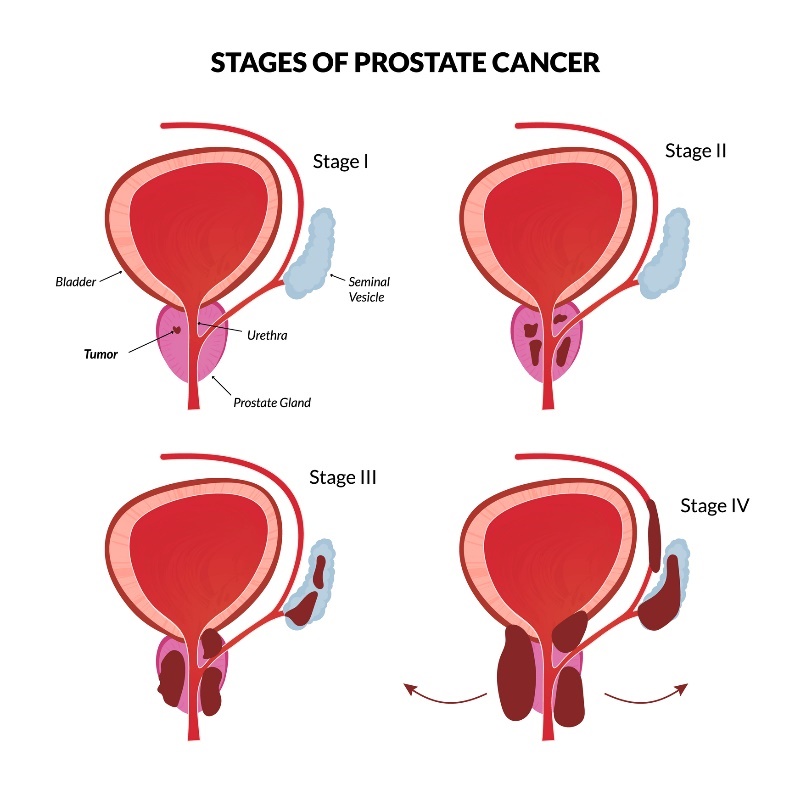 4 základné štádia rakoviny prostaty