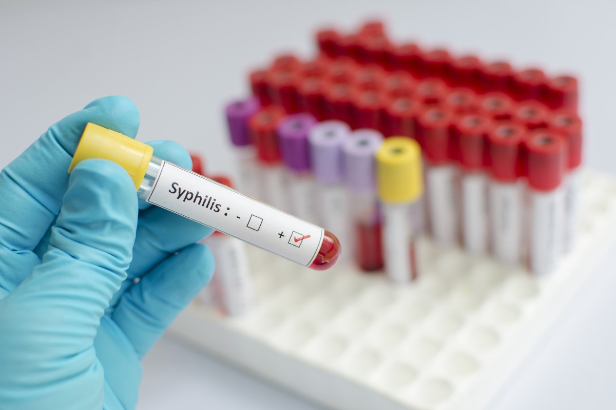 Syfilis: Aké má príznaky, štádiá, trvalé následky a liečbu?