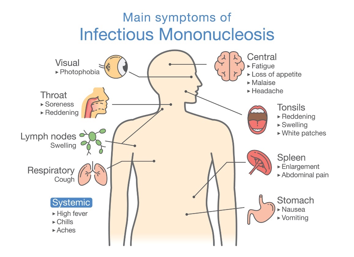 Symptómy infekčnej mononukleózy