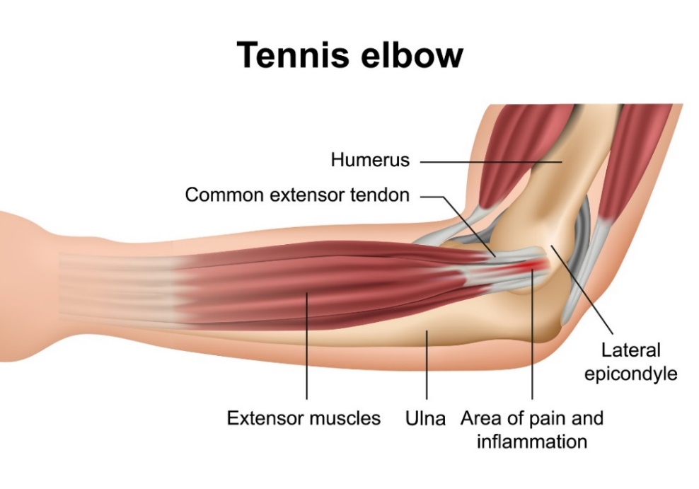Tenisový lakeť (laterálna epikondylitída): kosti lakťového kĺbu, svalové extenzory predlaktia, laterálny epikondyl a miesto primárnej bolesti