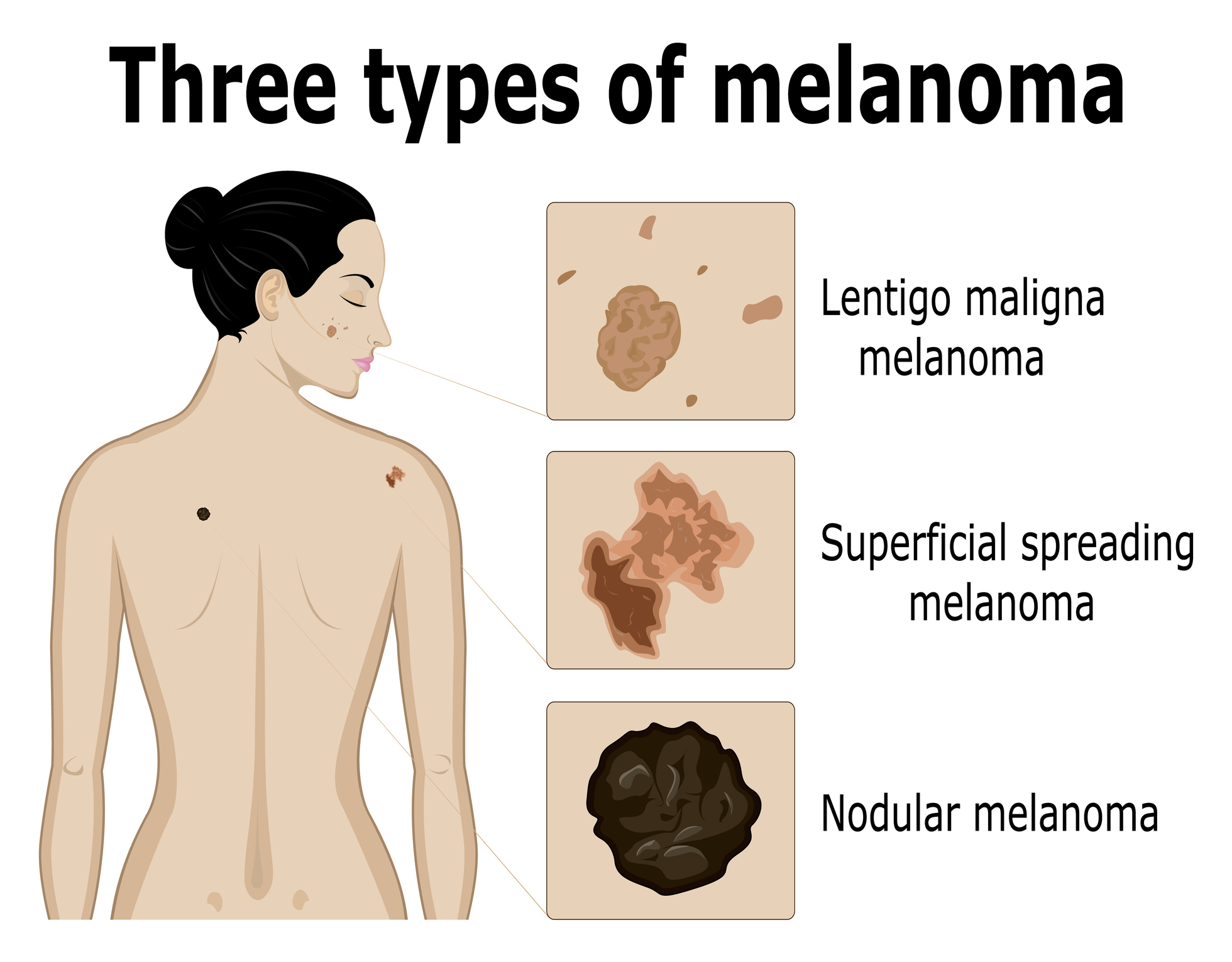 Zobrazenie troch typov melanómu