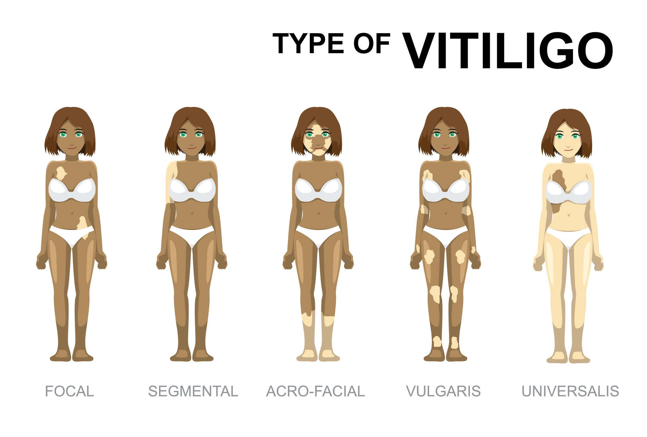 Typy vitiliga