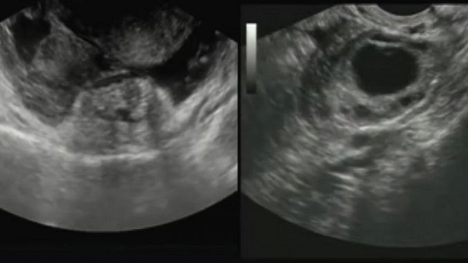 USG - sonografia brucha - obrázok na vyšetrení, zobrazenie maternice a mimomaternicového tehotenstva