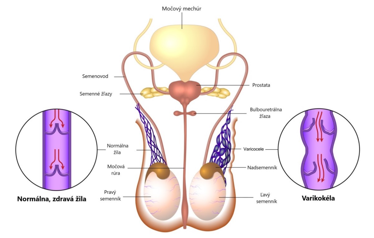 Anatomické zobrazenie mužského pohlavného ústrojenstva so zobrazením varikokély.
