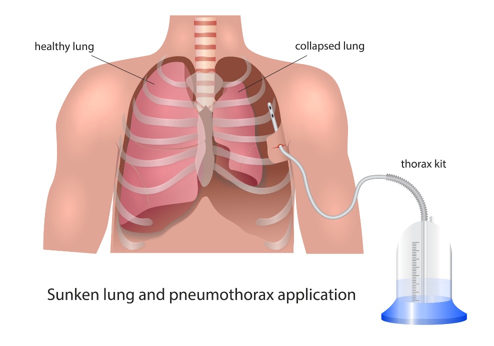 Vizualizácia Drenáže pleurálnej dutiny pri Pneumotoraxe: zdravé pľúca, kolabujúce pľúca a drenážny prístroj