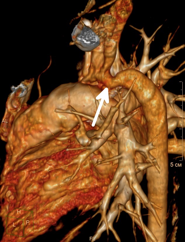Vizualizácia koarktácie (zúženie) aorty v descendentnej časti cievy srdca