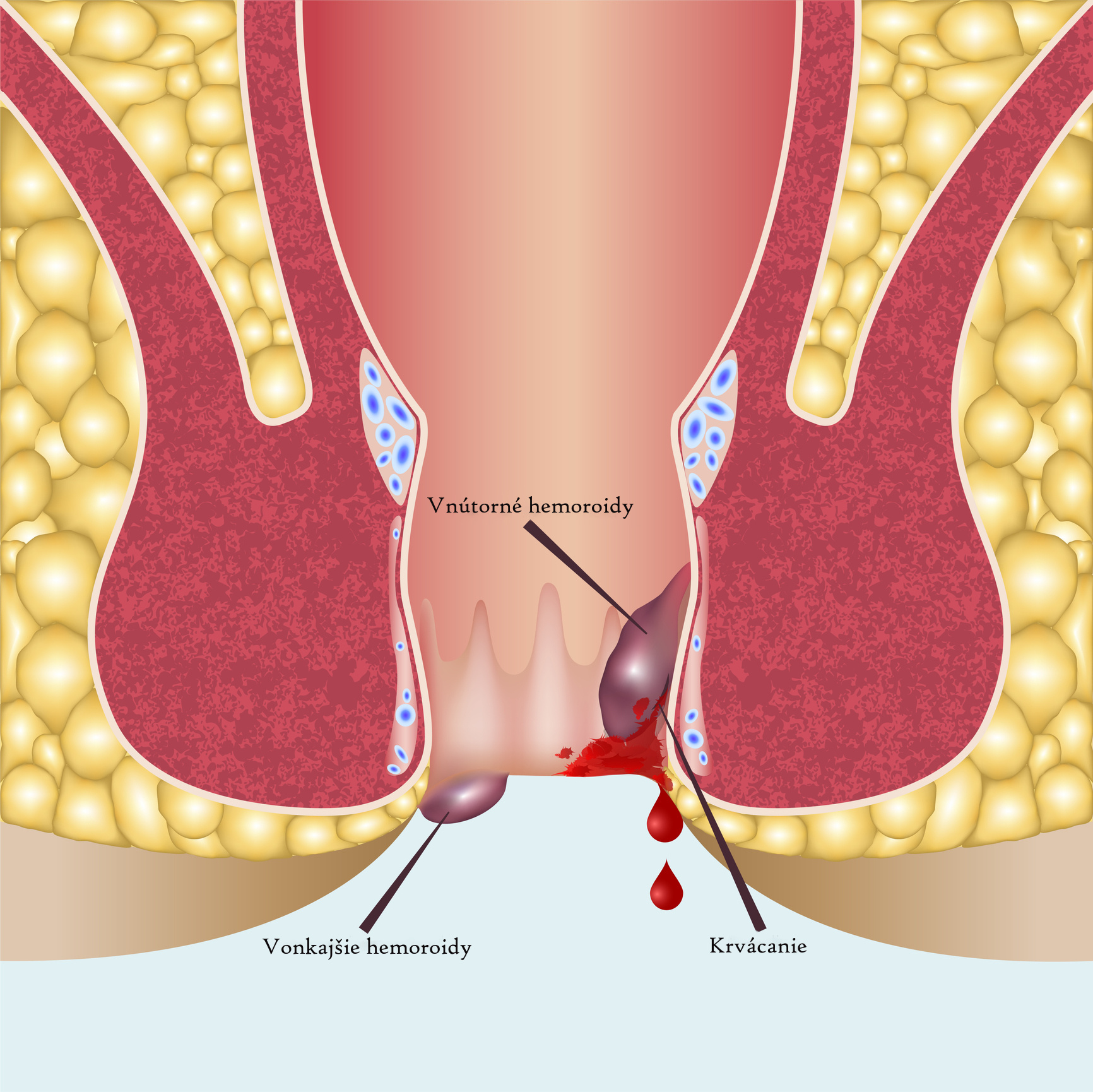 Anatomické zobrazenie rozdielu vnútorných a vonkajších hemoroidov + krvácanie
