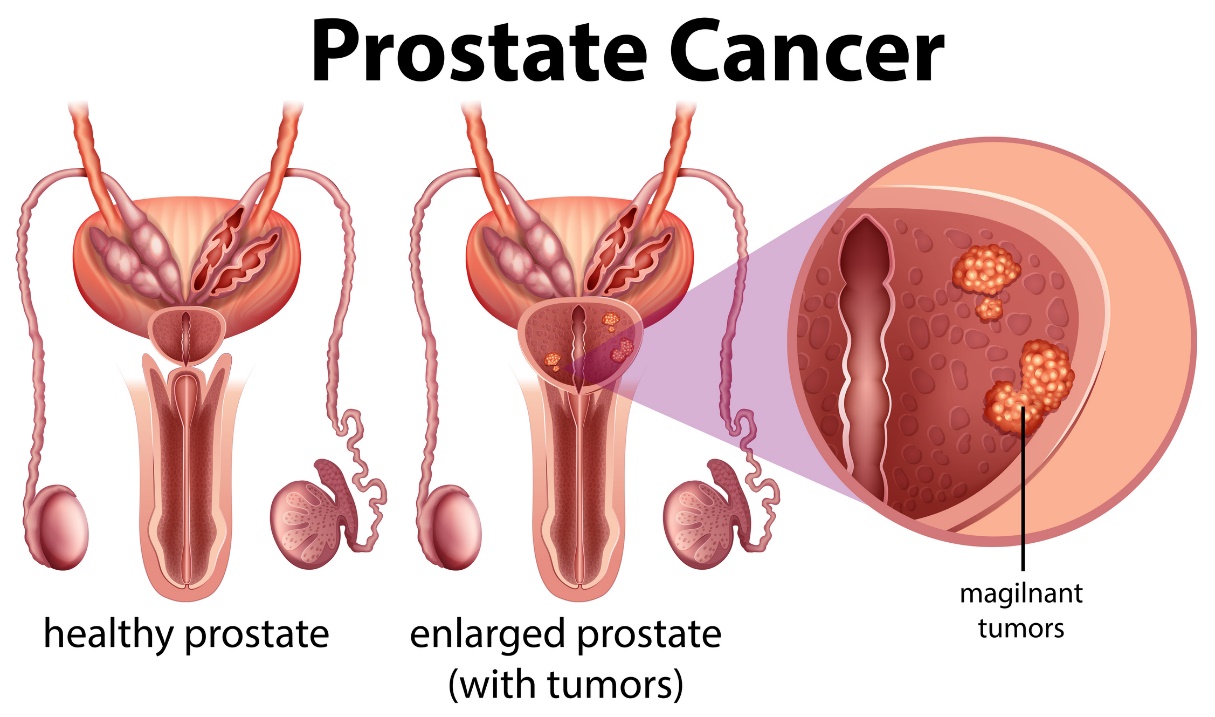 Rakovina prostaty. Zdravá prostata a zväčšená prostata s tumorom