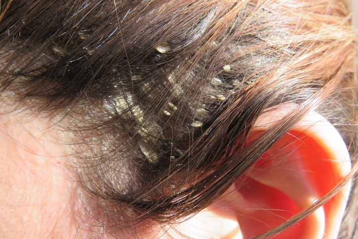 Žena má problém s lupinami vo vlasoch