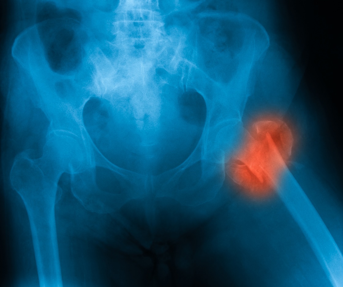 Zlomenina krčka stehennej kosti