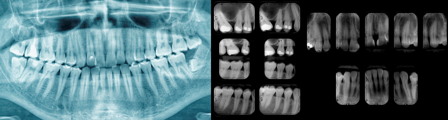 Zubný RTG sníkom, ktorý ukáže stav chrupu, zubný kaz aj výplne