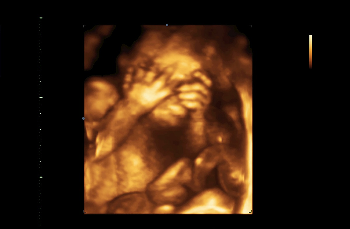 4D-Sonographie, der Fötus im 6. Schwangerschaftsmonat bedeckt das Gesicht, an den Händen ist noch ein deutlicher Mangel an subkutanem Fett zu erkennen. 