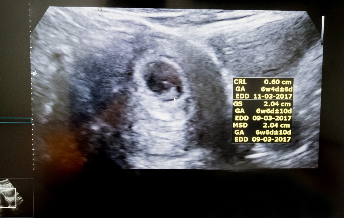 Sonografický snímok embrya v 6. týždni tehotenstva. Zdroj: Getty Images
