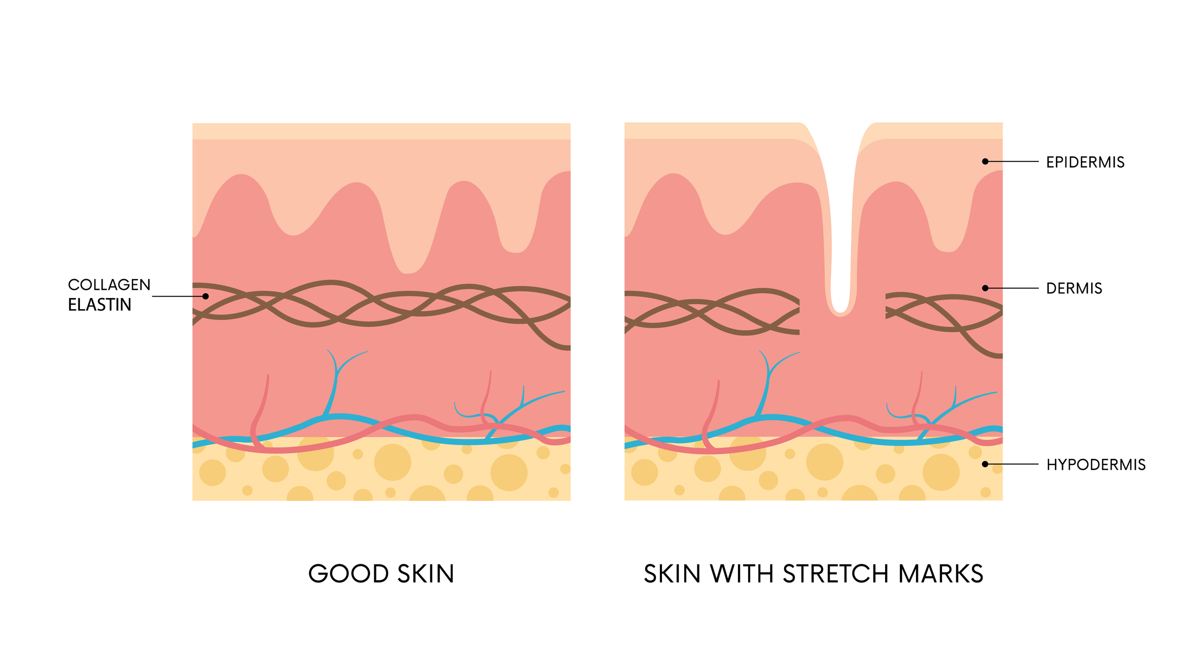 Animovaný model: porovnania zdravej pokožky a pokožky poškodenej striami