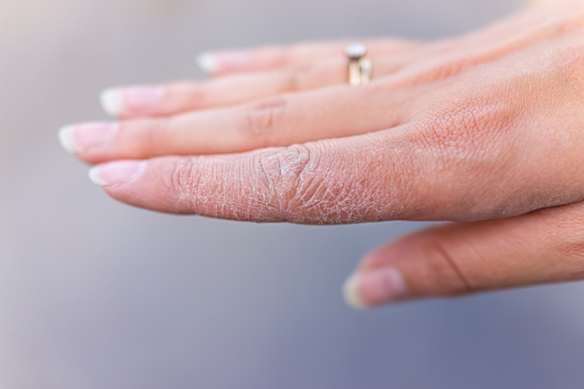 Glycerol pomáha na suchú pokožku - ženská ruka so suchou a popraskanou kožou