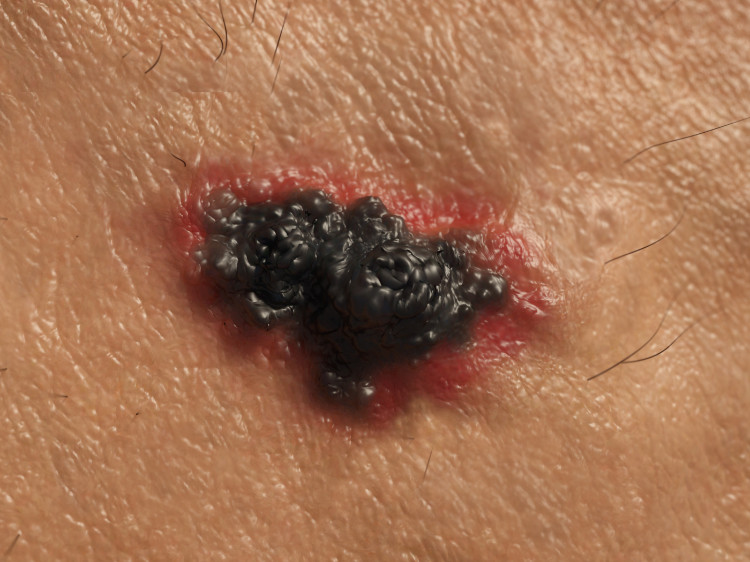 rakovina kože, malígny melanóm čiernej farby s červenými okrajmi