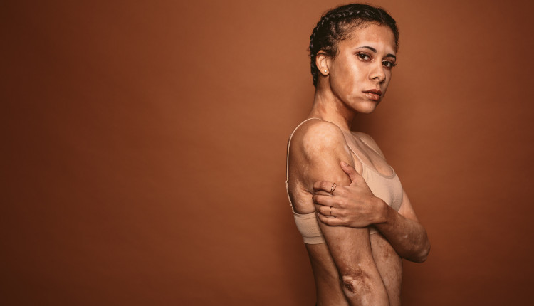 žena s bielymi fľakmi po tele - vitiligo