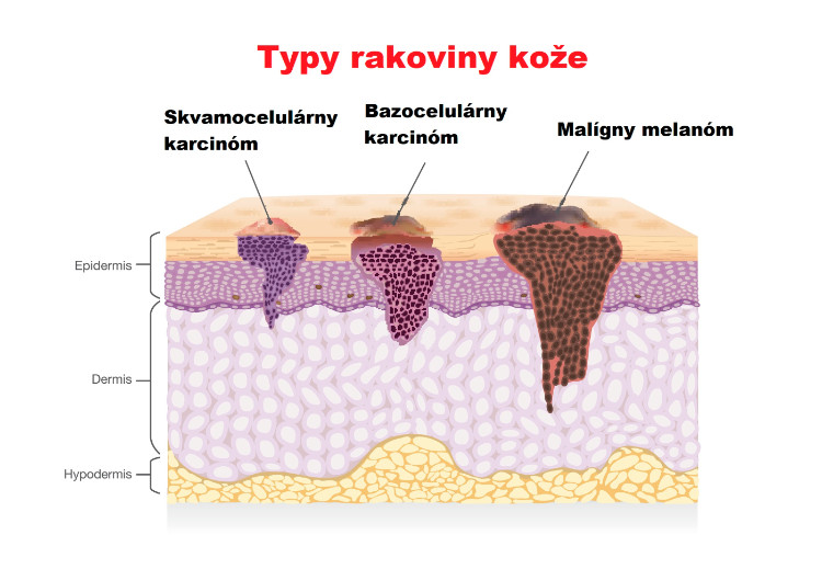 prierez kožkou so zobrazením troch typov rakoviny kože