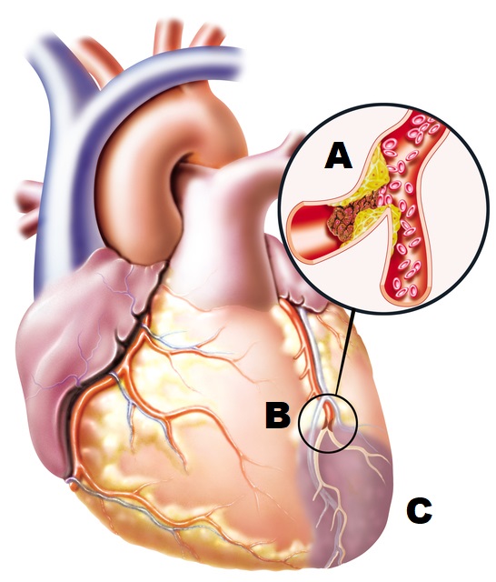 anatomický nákres srdca s upchatou cievou