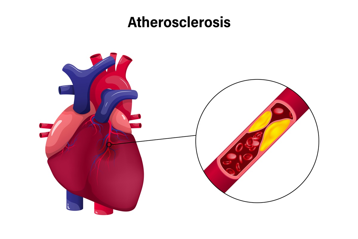 Ateroskleróza ako časté ochorenie srdca a ciev