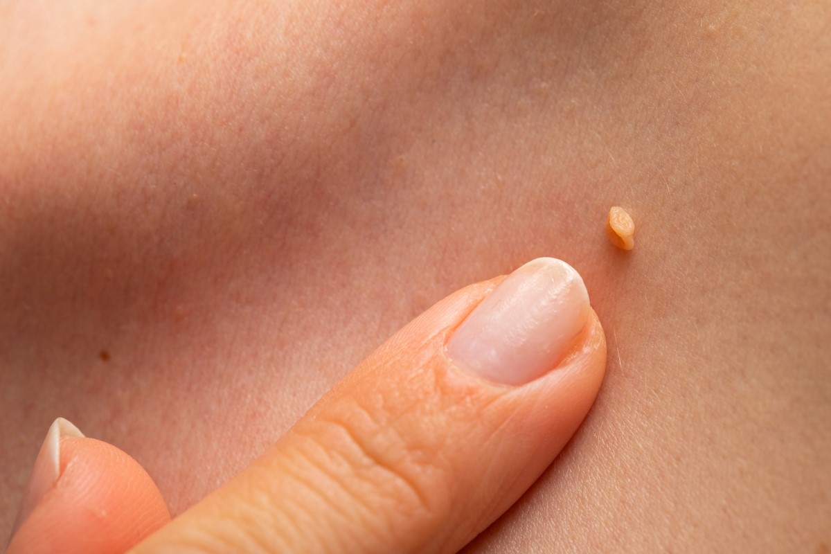 Bradavica HPV na koži ženy
