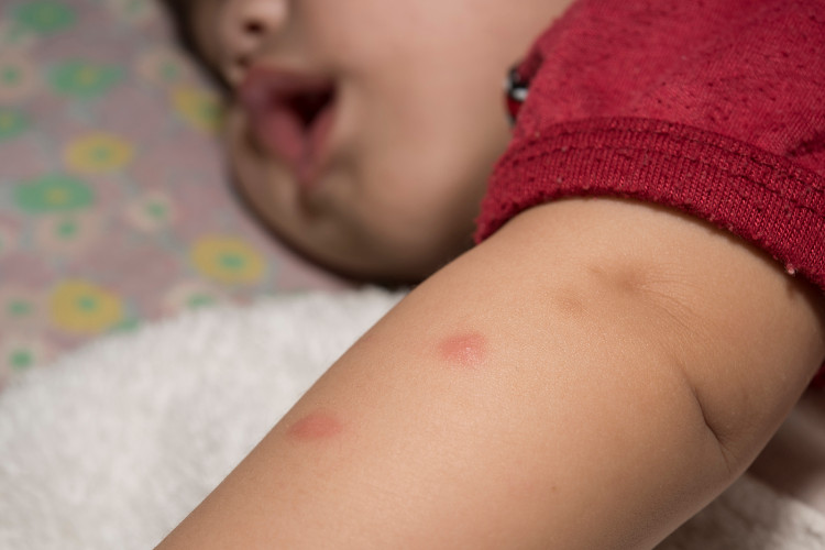 dieťa v červenom tričku s poštípanou rukou od komára