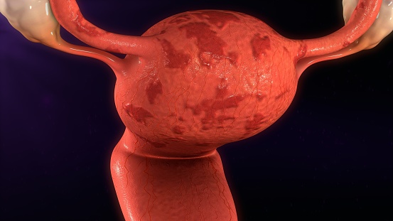 Endometrióza a neplodnosť
