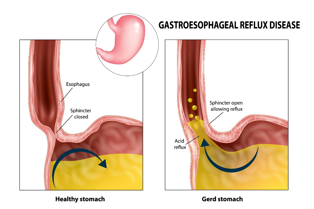 Gastro-ezofageálny reflux: pažerák, zvierač, žalúdok a žalúdočná kyselina