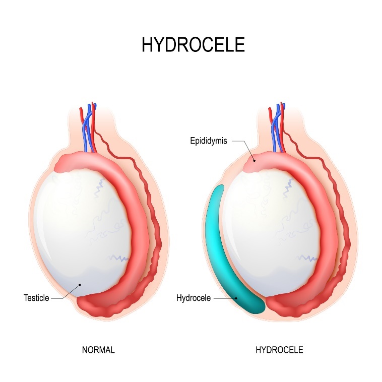 Hydrokéla: Testicle (semeník), Epididymis (nadsemenník), Hydrocele (nahromadená tekutina)