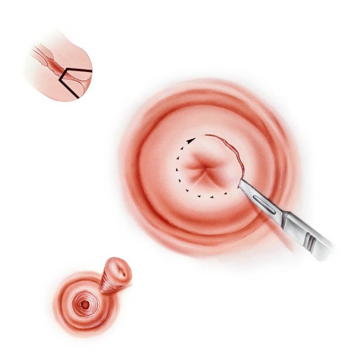 Konizácia krčka maternice skalpelom